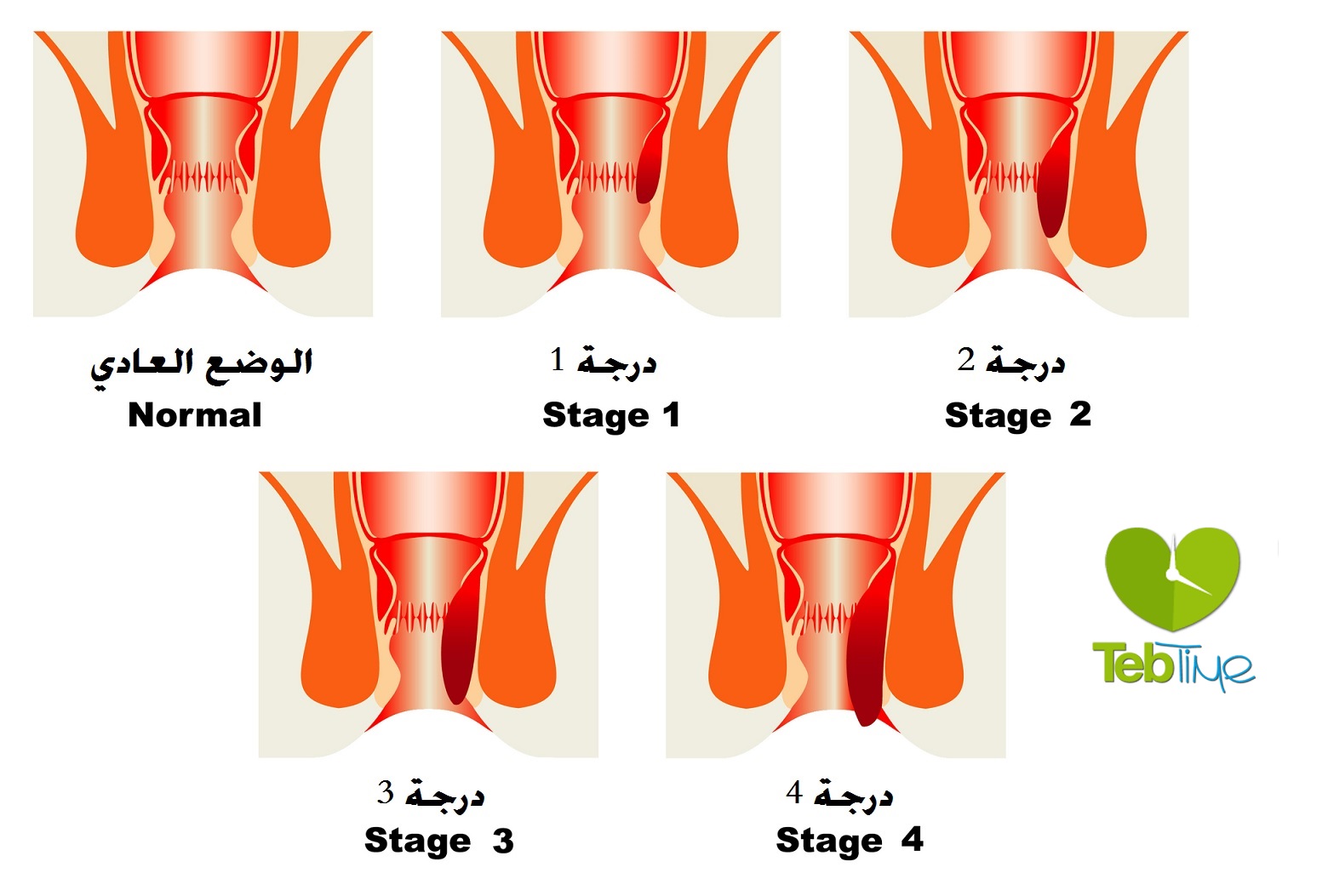 علاج البواسير الداخلية في المنزل بطرق مختلفة